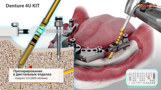 Denture 4U KIT