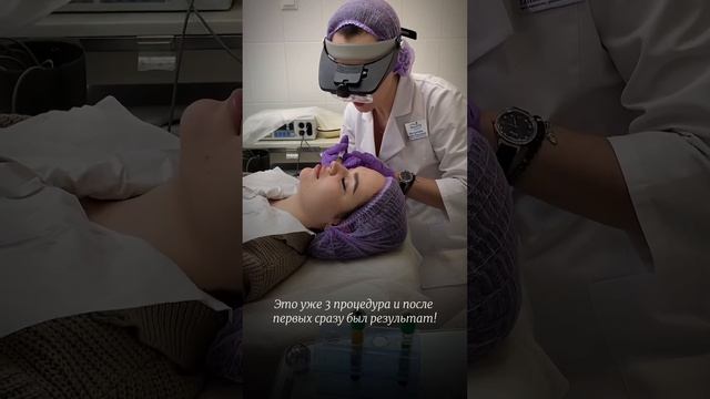 Лечение акне