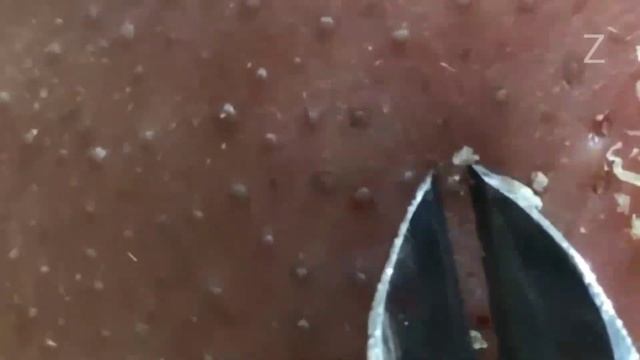 Cabut komedo sampai bolong