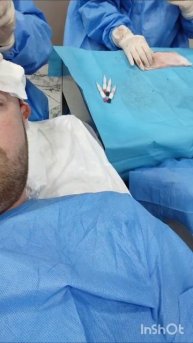 Пересадка волос, Турция