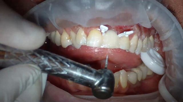 Dental composite bridge - Time lapse video
