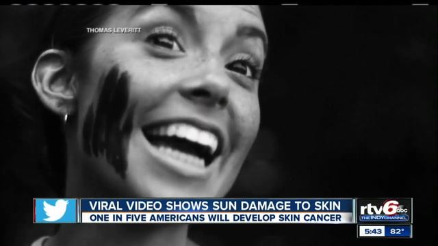 Video: UV camera shows harsh realities of sun damage