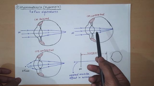 Refractory Errors Of Eye | Myopia | Hypermetropia || Special Senses Physiology