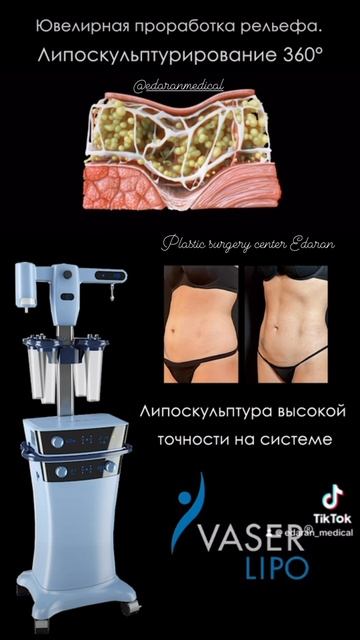 Ультразвуковая Vaser-липосакция