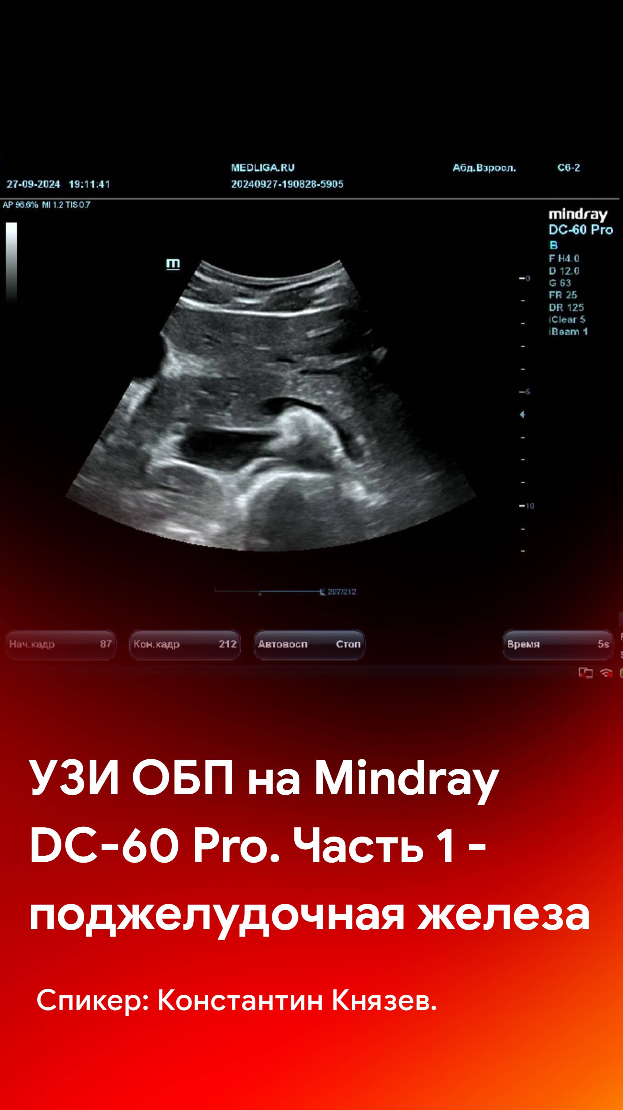 УЗИ поджелудочной железы в рамках исследования брюшной полости на Mindray DC-60 Pro