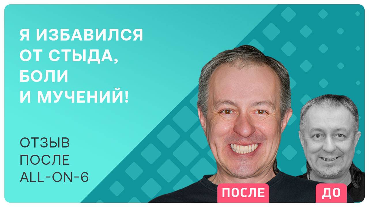 Советы пациента для тех, кто сомневается, делать ли имплантацию всех зубов