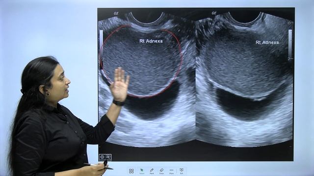 Endometriosis Part : 2 | Management