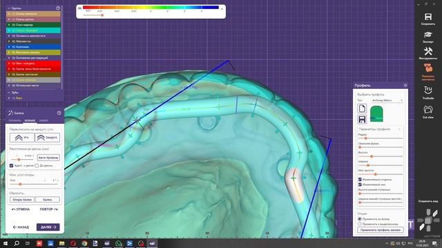 Моделирование рельсовой балки с уровня имплантов с замками Bredent