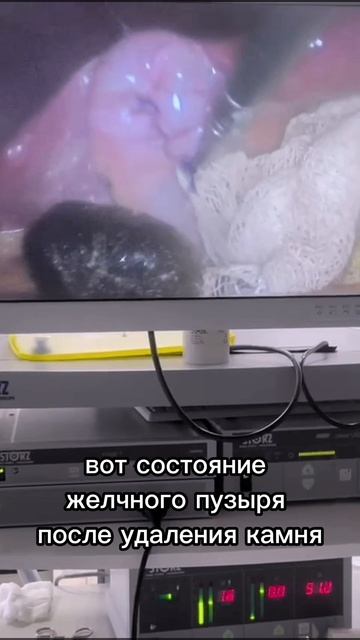 МОЖНО ЛИ СОХРАНИТЬ ЖЕЛЧНЫЙ ПУЗЫРЬ И УДАЛИТЬ ИЗ НЕГО ТОЛЬКО КАМНИ?