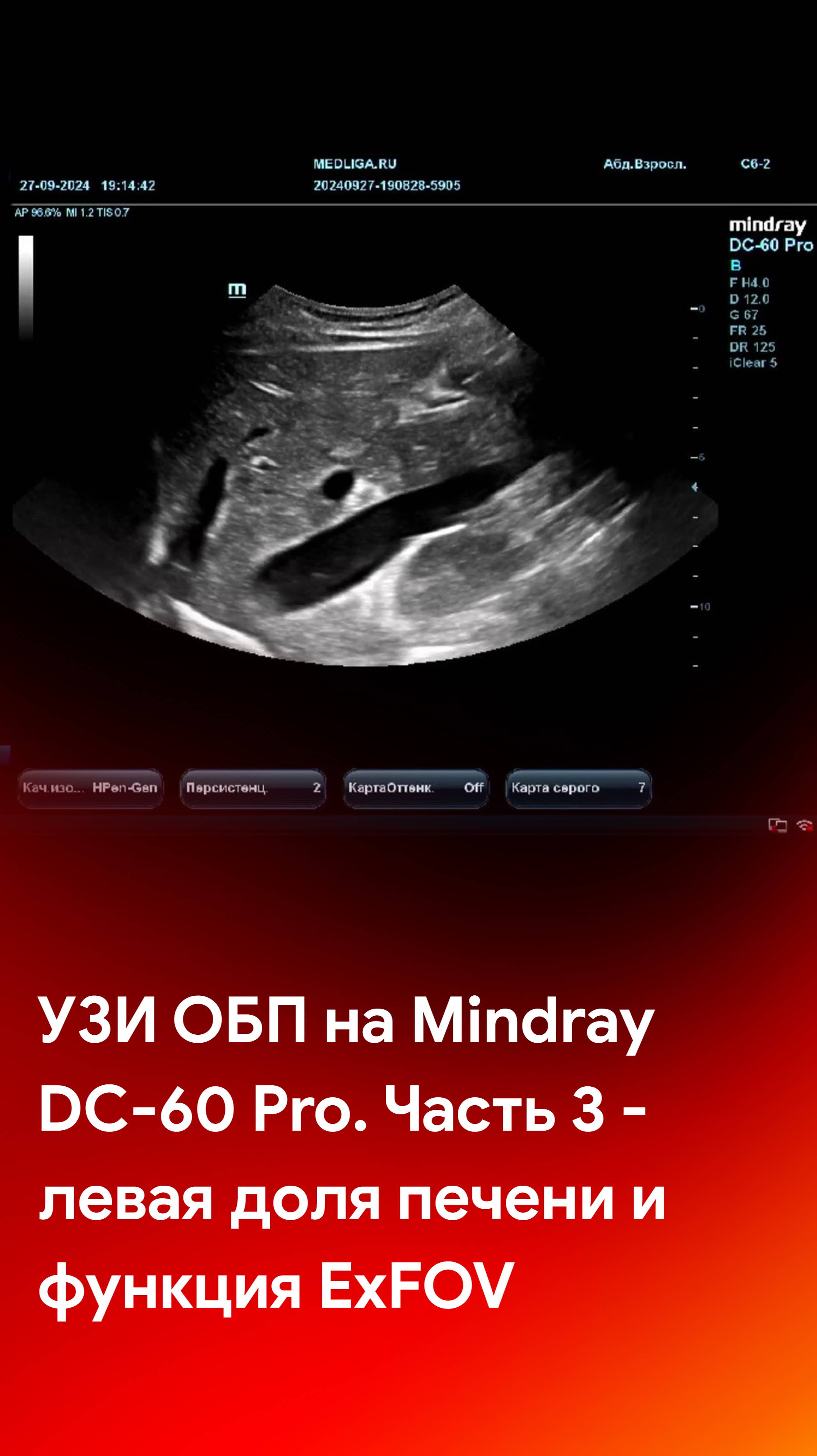 Левая доля печени и функция ExFOV на УЗИ брюшной полости
