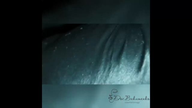 Механическая чистка лица
