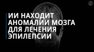 ИИ находит аномалии мозга для лечения эпилепсии
