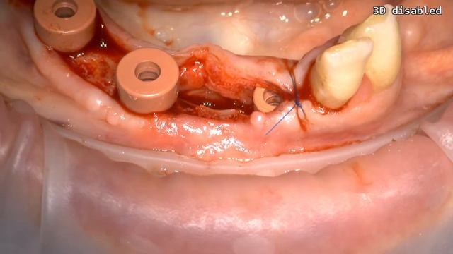 Применение MUCOGRAFT