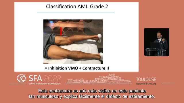 Mise au point sur l'Inhibition Motrice d'origine Centrale dans les suites d'une entorse du Genou