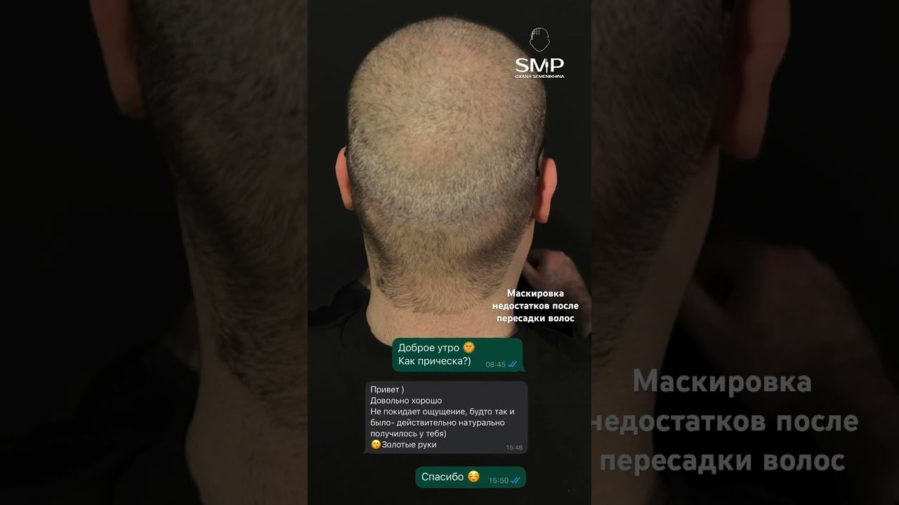 Маскировка шрамов после пересадки