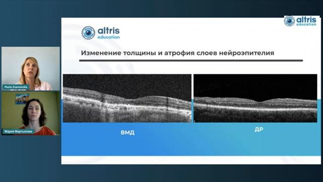 ОКТ-диагностика сочетания диабетической ретинопатии и влажной ВМД (360p)