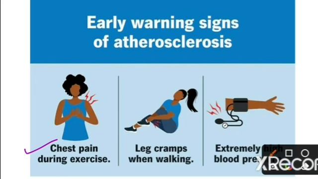 Atherosclerosis - Causes, sign and symptoms, treatment | Circulatory system disease