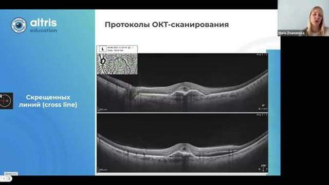 ОКТ-протоколы при сканировании макулярной зоны сетчатки (1)