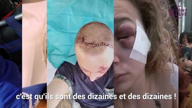 GILETS JAUNES _ LES BLESSÉS QUI DÉRANGENT