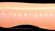 Skin Graft