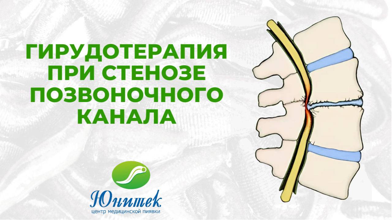 Гирудотерапия при стенозе позвоночного канала