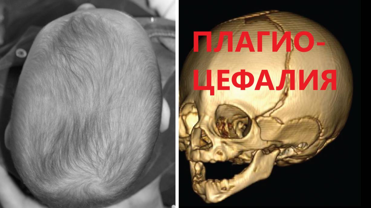 Плагиоцефалия у ребенка. Поможет ли остеопат?