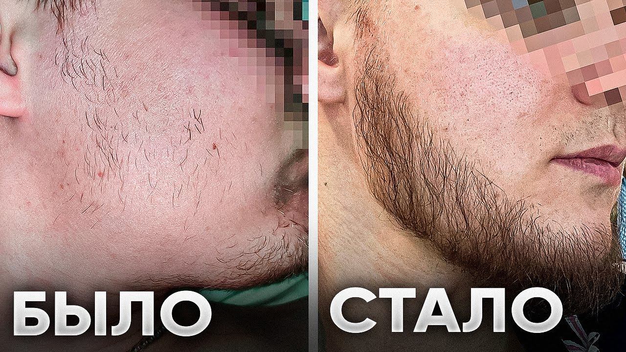 от ПАЦАНА до БРУТАЛА за 5 месяцев! Результаты средства для роста бороды