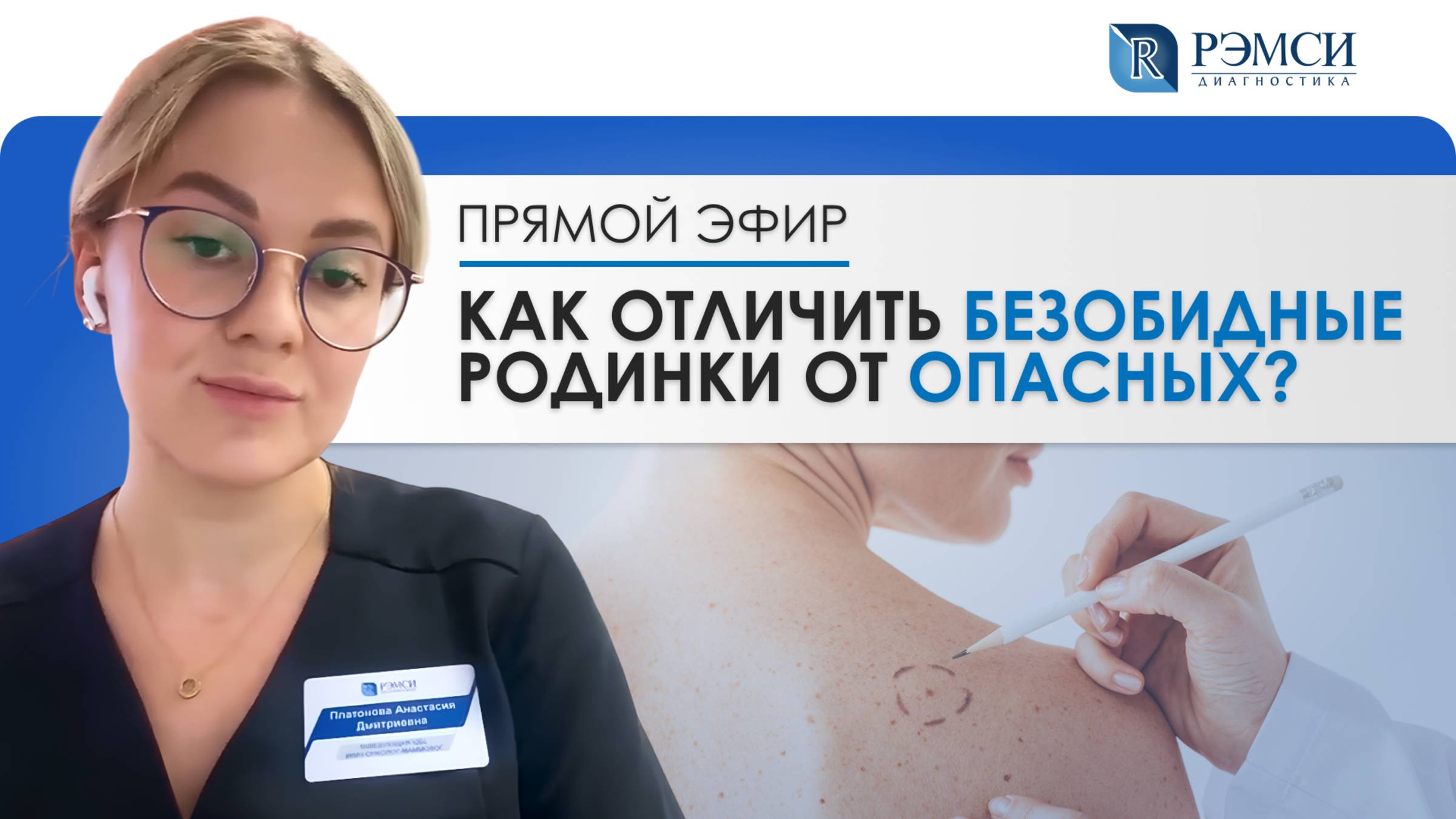 Как отличить безобидные родинки от опасных?