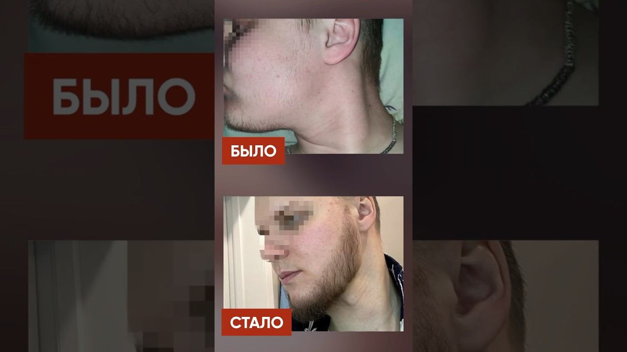 За 5 месяцев отрастил ГУСТУЮ бороду! Средство для роста бороды