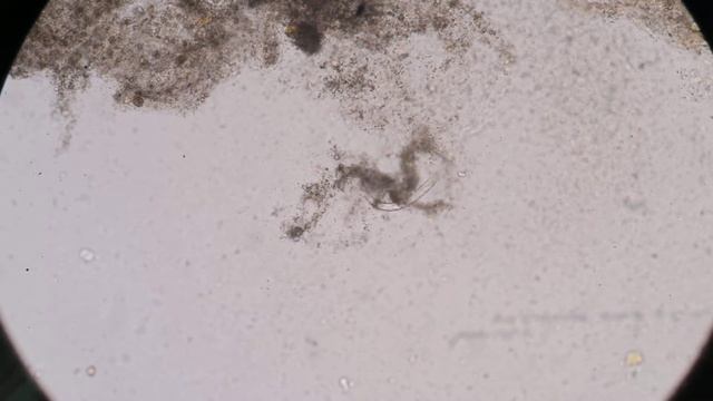 Strongyloides stercoralis (threadworm) in stool, analyze by microscope