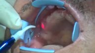 Dental diode Laser