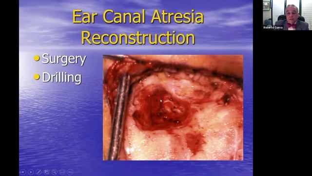 Ear Canal Atresia Reconstruction | House Online Neurotology Education Program