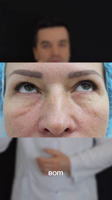 круговая блефаропластика