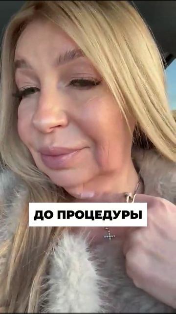 Пациентка до и после процедур, проведенных в клинике Laguna Vip