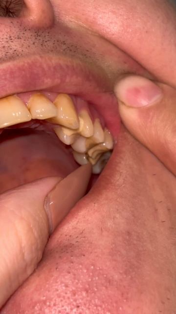 Когда ты не ожидал, что сухарики могут стать причиной визита к стоматологу. Слабонервным не смотреть