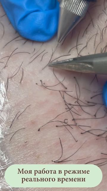 Процесс электроэпиляции