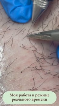 Процесс электроэпиляции