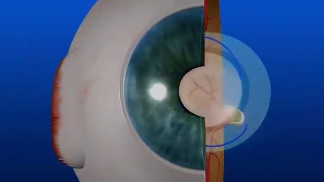 Cataract Laser Treatment