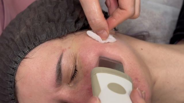 Ультразвуковая чистка лица