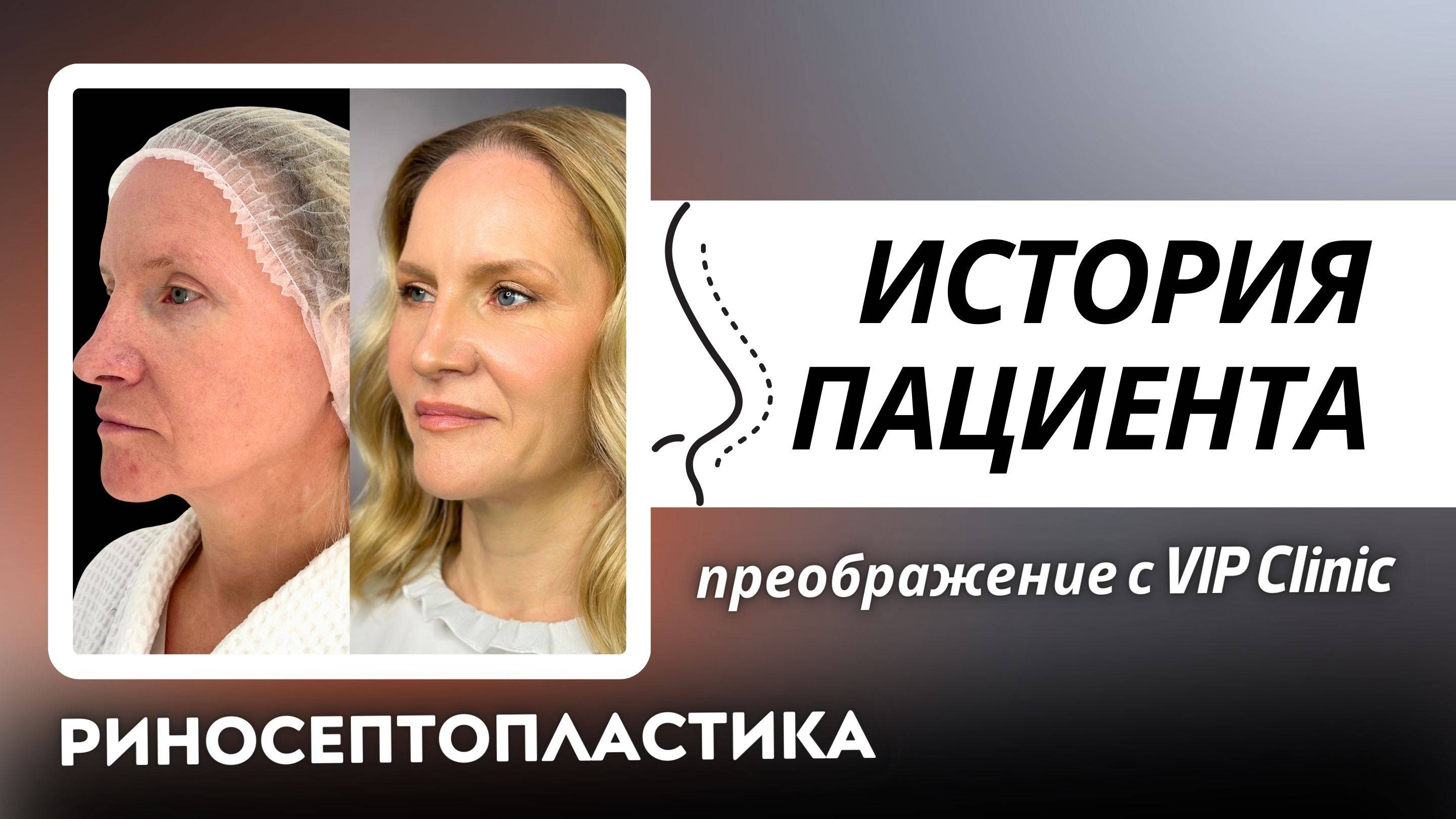 УЛУЧШЕНИЕ ДЫХАНИЯ с помощью РИНОПЛАСТИКИ | история пациента VIP Clinic