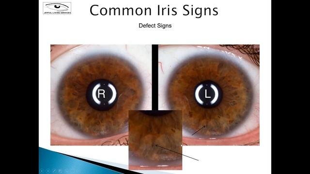 Common Iris Signs