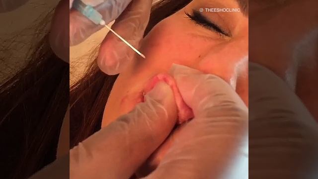 Here's What Happens When Lip Fillers Go Wrong (GRAPHIC FOOTAGE)