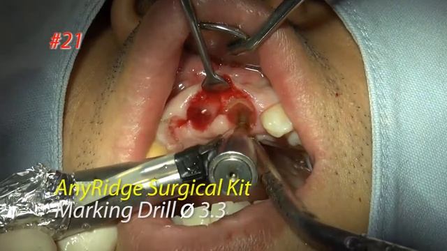 Dr. Chang Hoon Han Root Membrane Technique  Surgery #12,21