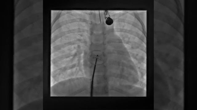 ASD Occluder release from Right Upper Pulmonary Vein