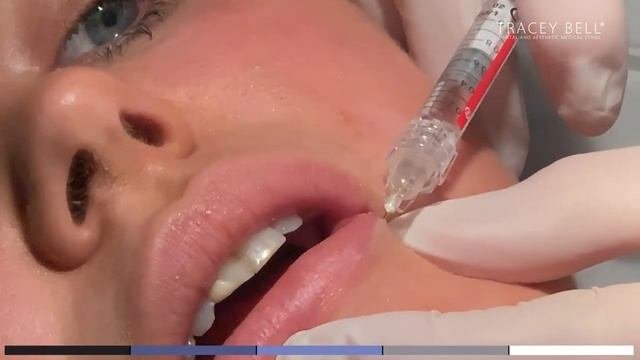 Belotero Lip Injections Uk