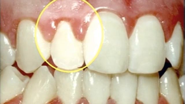 Periodontal Disease South Florida Dentist