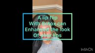 Forehead and Lip Flip Botox Treatment| #botox #lipinjections #lipflip #foreheadlines