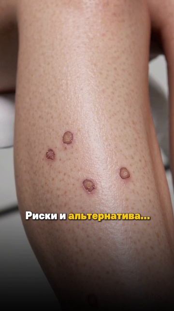 Эпиляция в солнечный период: что предложить клиенту?