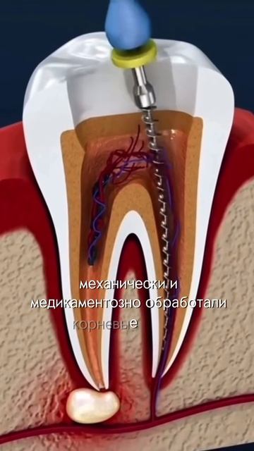 Почему зуб лечат в 2 посещения?