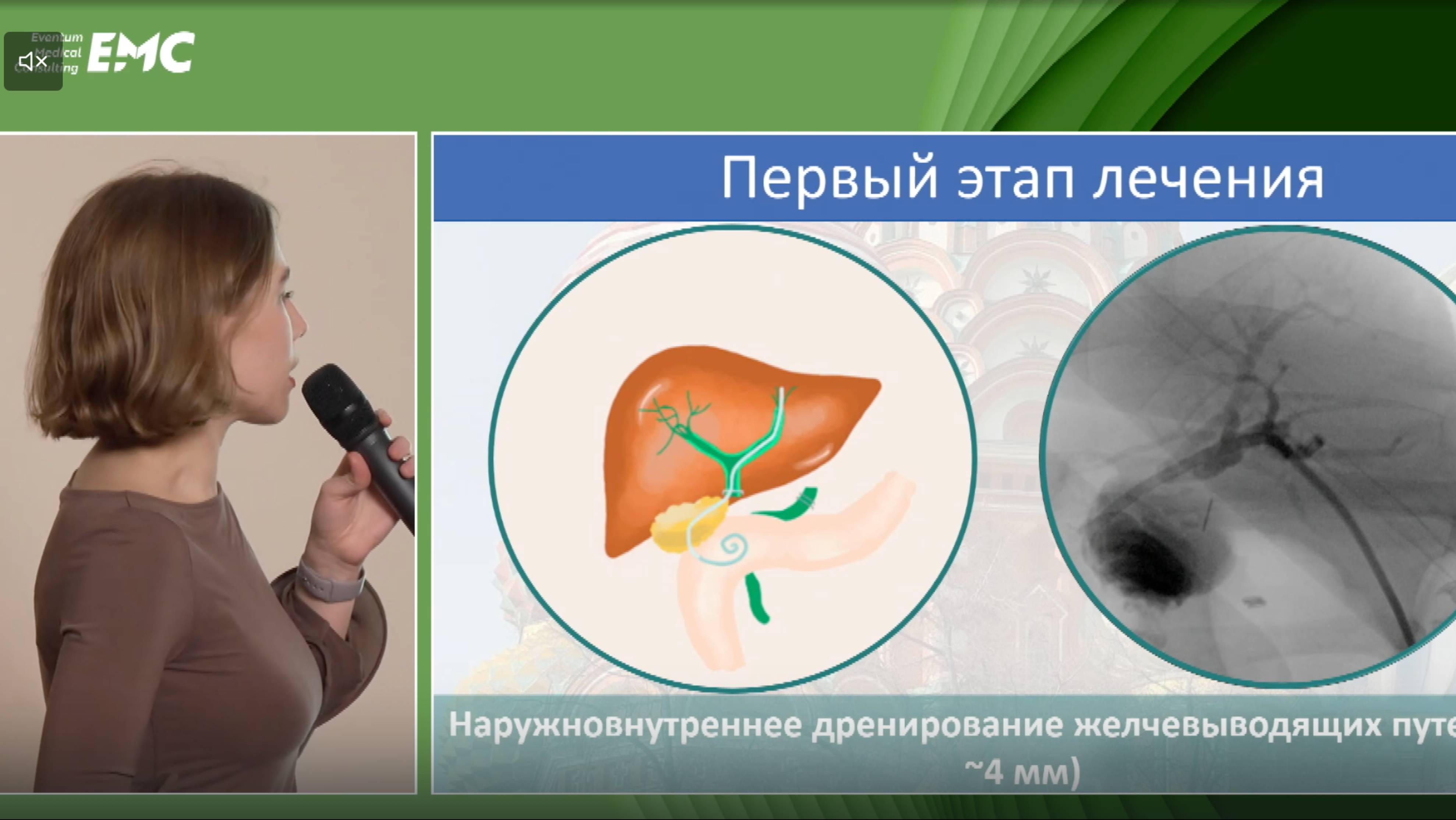 1 Козлова ПС Возможности рентген-эндоскопических вмешательств в коррекции "свежих" повреждений ЖВП